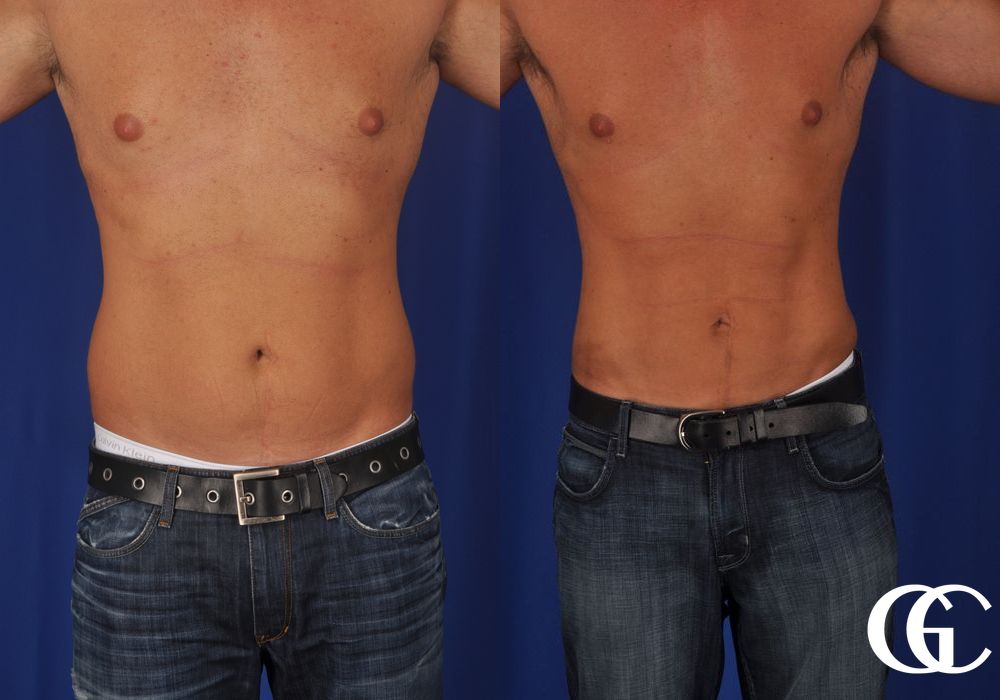 Liposuction - Case 6922