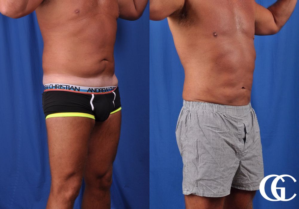 Liposuction - Thumbnail 2