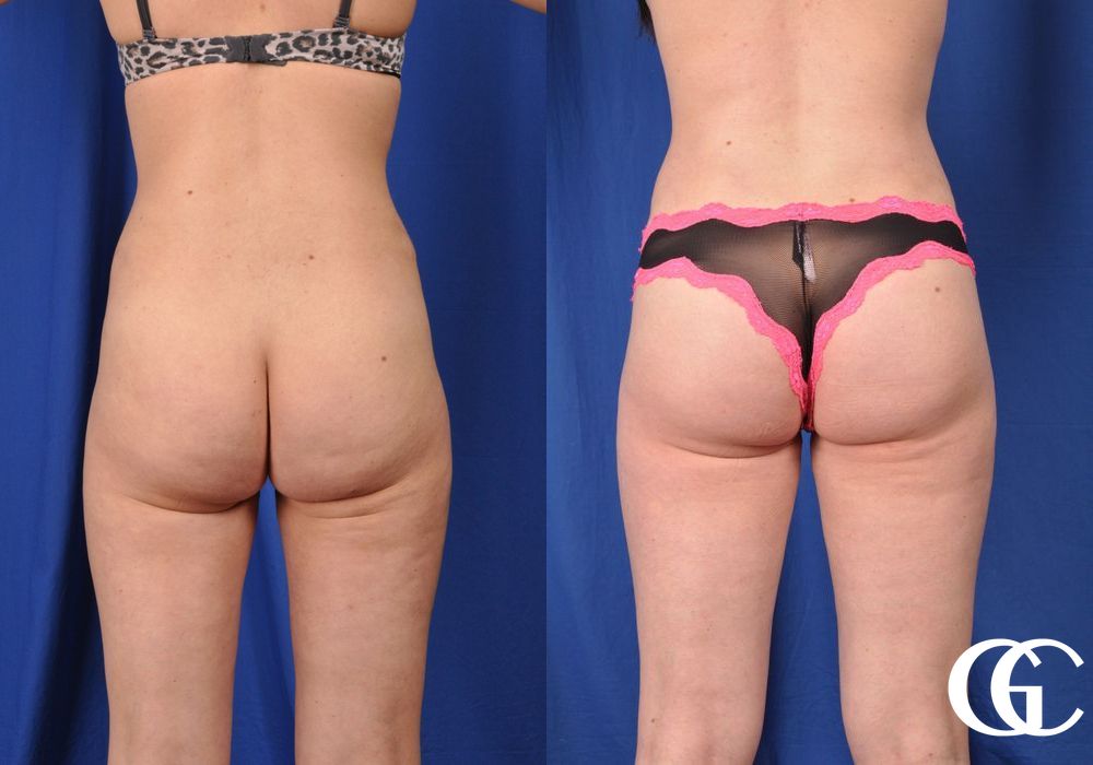 Liposuction - Thumbnail 4