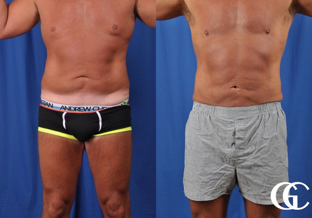 Liposuction - Case 6960