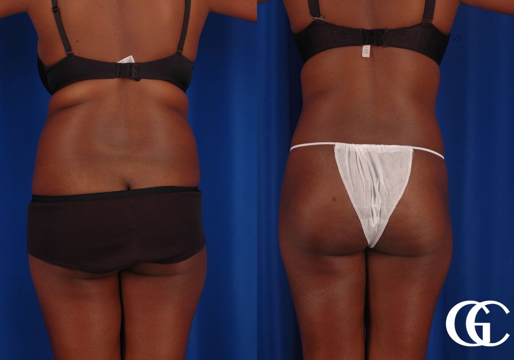 Liposuction - Case 6970
