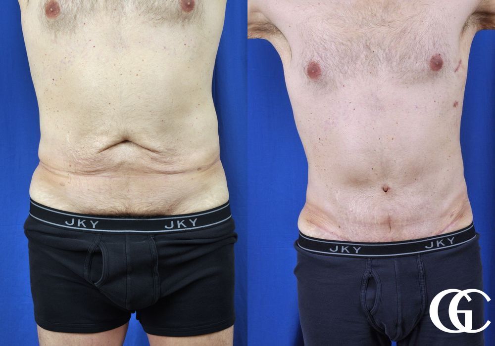Liposuction - Case 6966