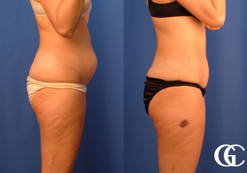 Liposuction - Thumbnail 2