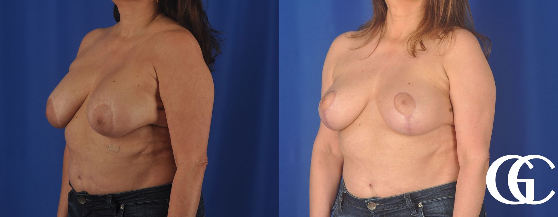 Liposuction - Thumbnail 4