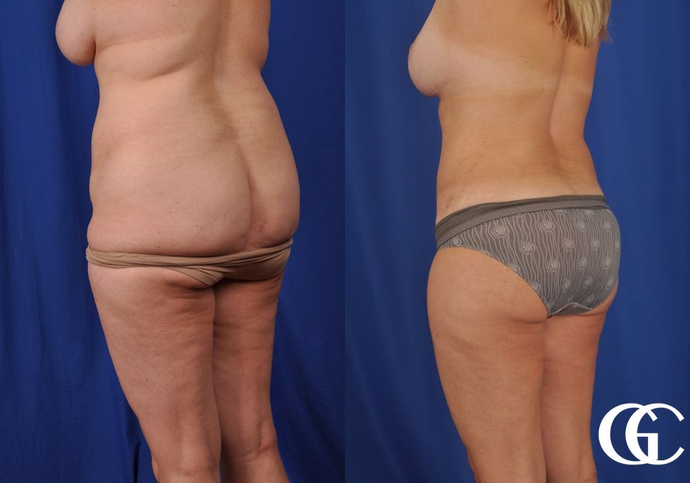 Liposuction - Thumbnail 5