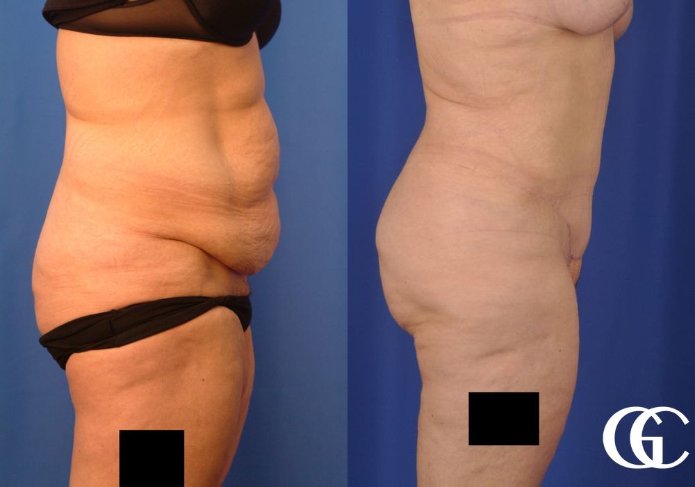 Liposuction - Thumbnail 2