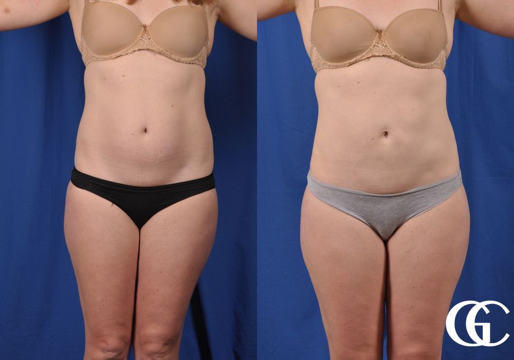 Liposuction - Thumbnail 2