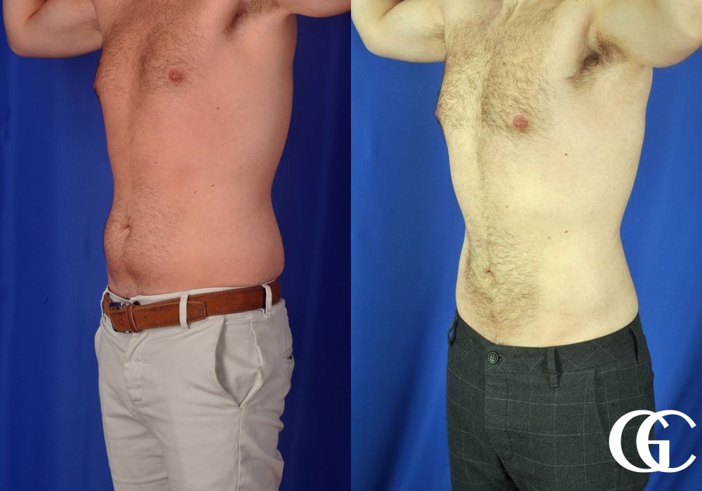 Liposuction - Thumbnail 5