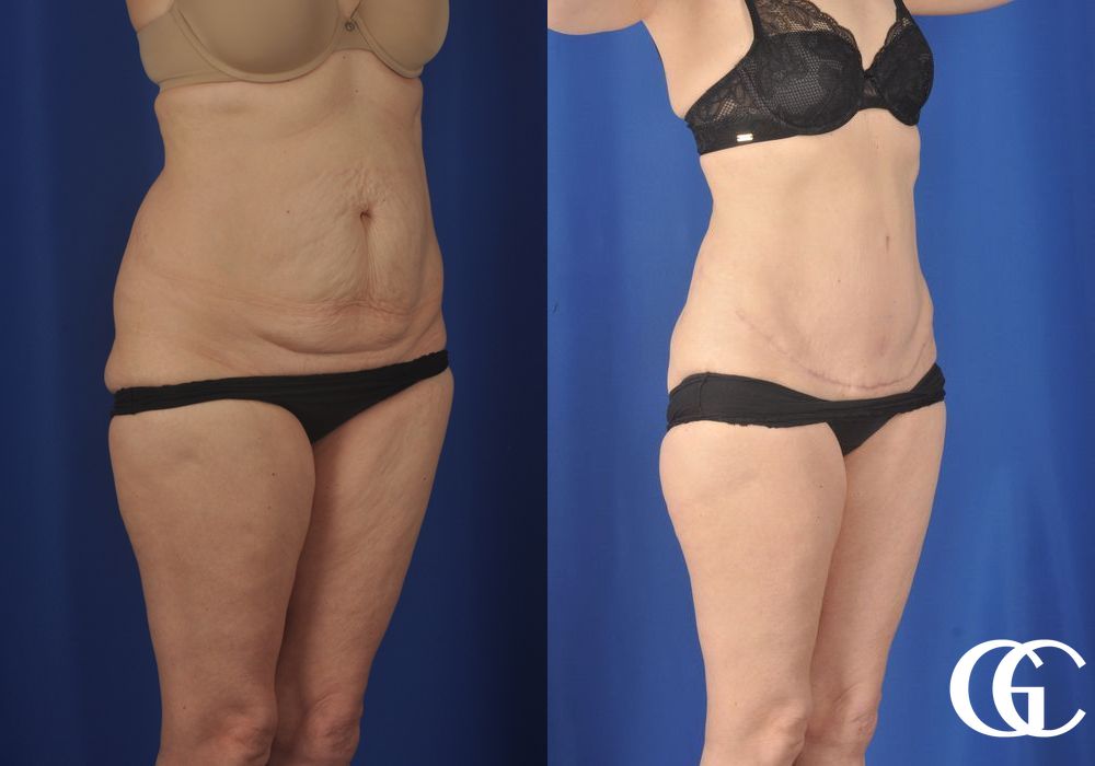 Liposuction - Thumbnail 2