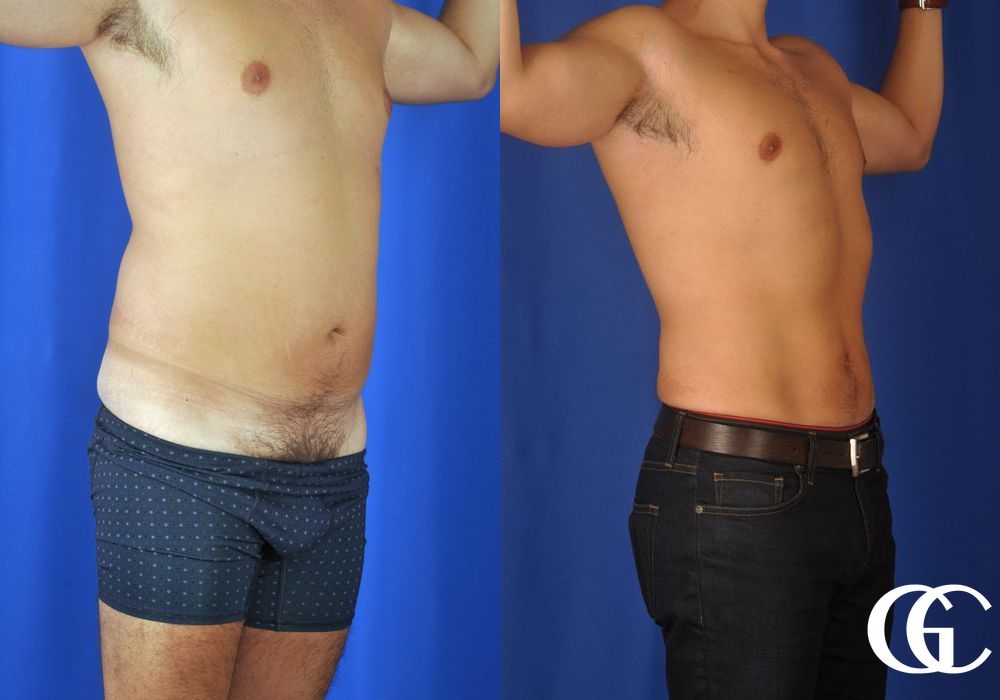 Liposuction - Thumbnail 2