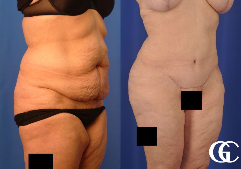 Liposuction - Case 6944