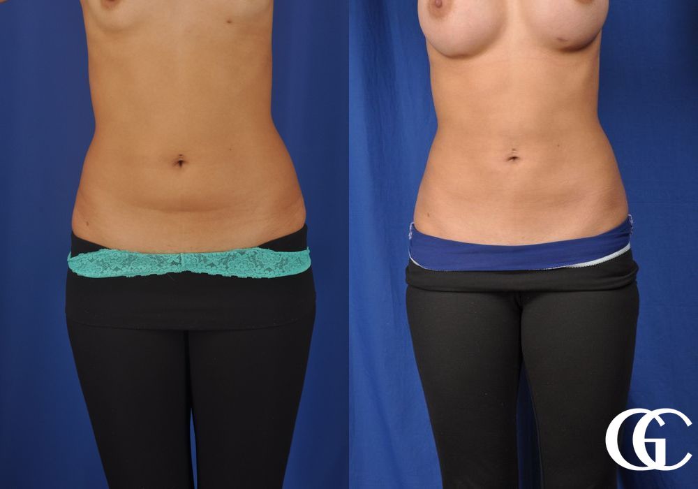 Liposuction - Case 6950