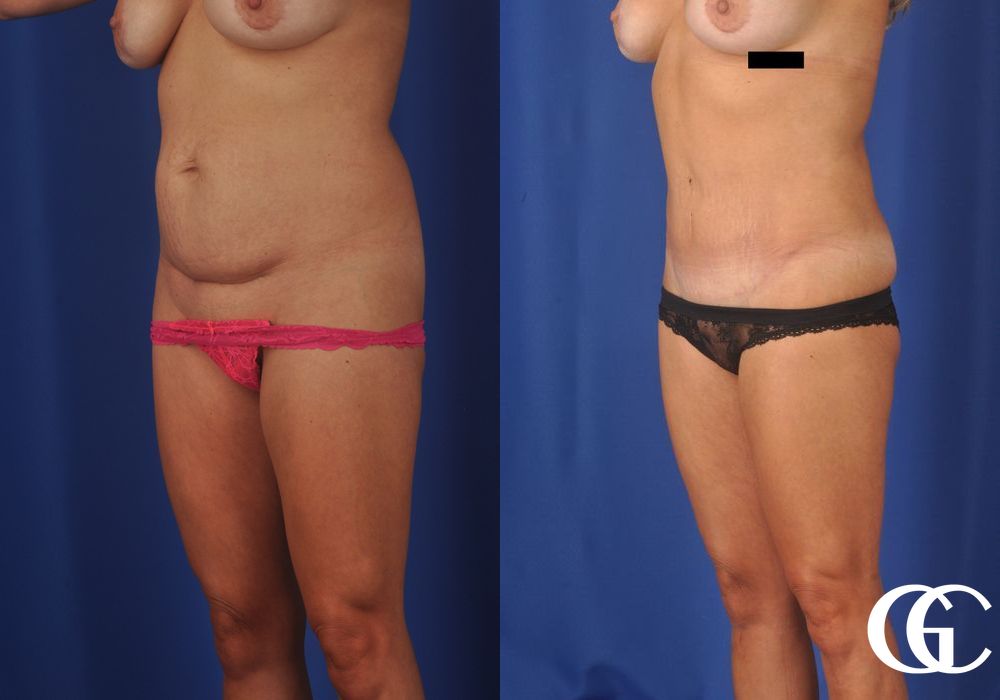 Liposuction - Thumbnail 2