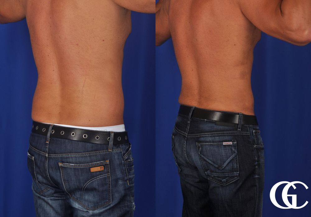 Liposuction - Thumbnail 3