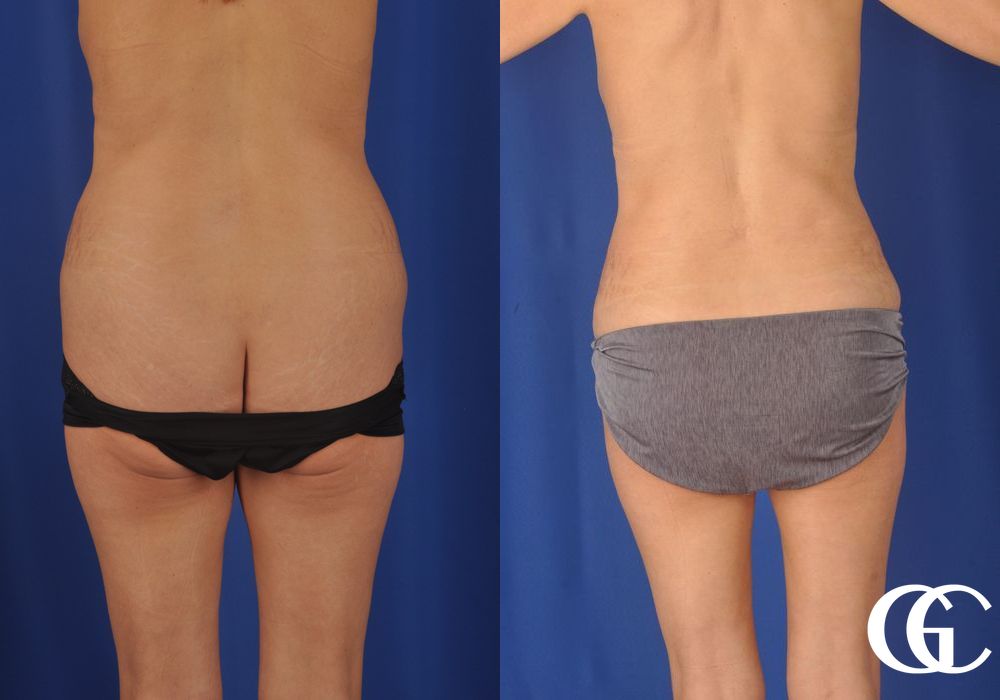 Liposuction - Thumbnail 4