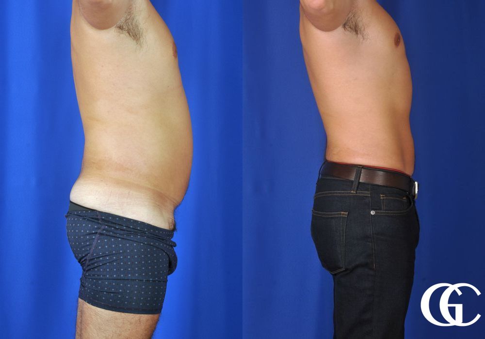 Liposuction - Thumbnail 3