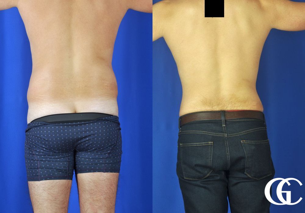 Liposuction - Thumbnail 5
