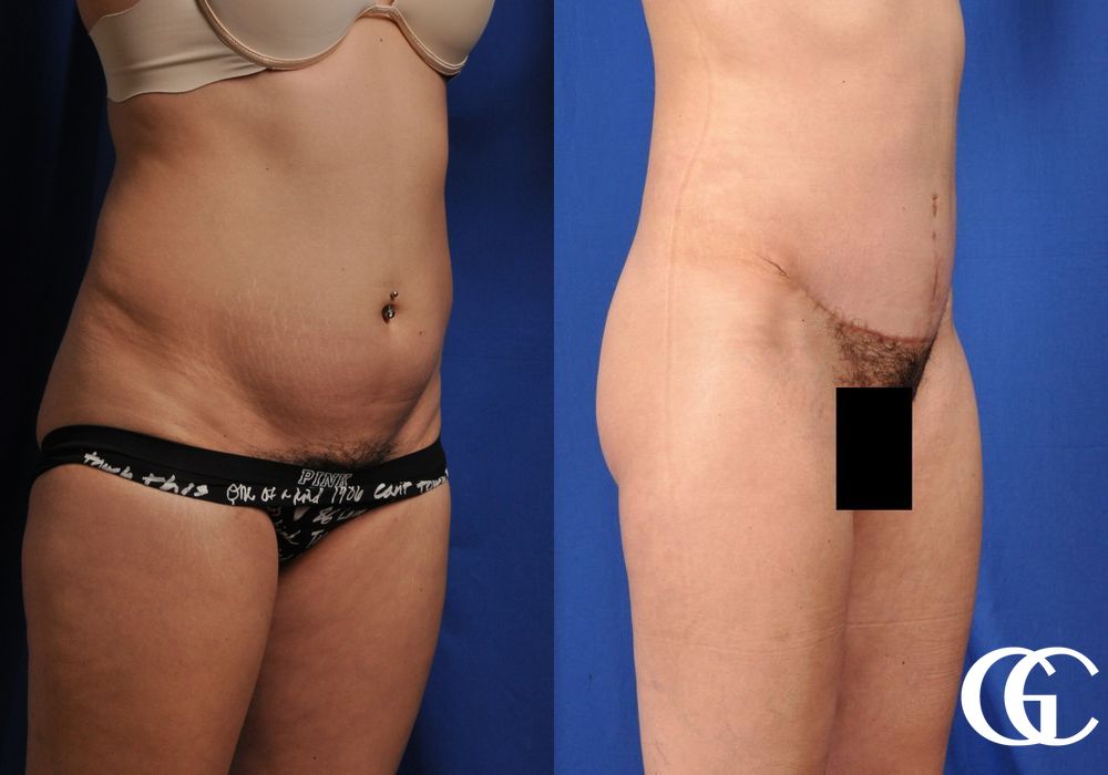 Tummy Tuck - Thumbnail 3