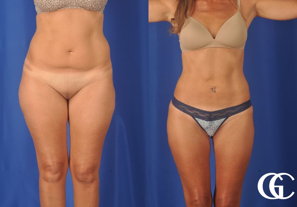 Liposuction - Thumbnail 2