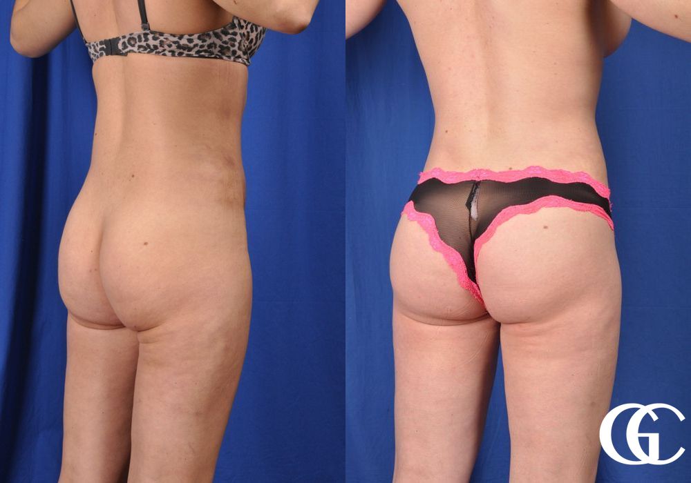 Liposuction - Case 6948