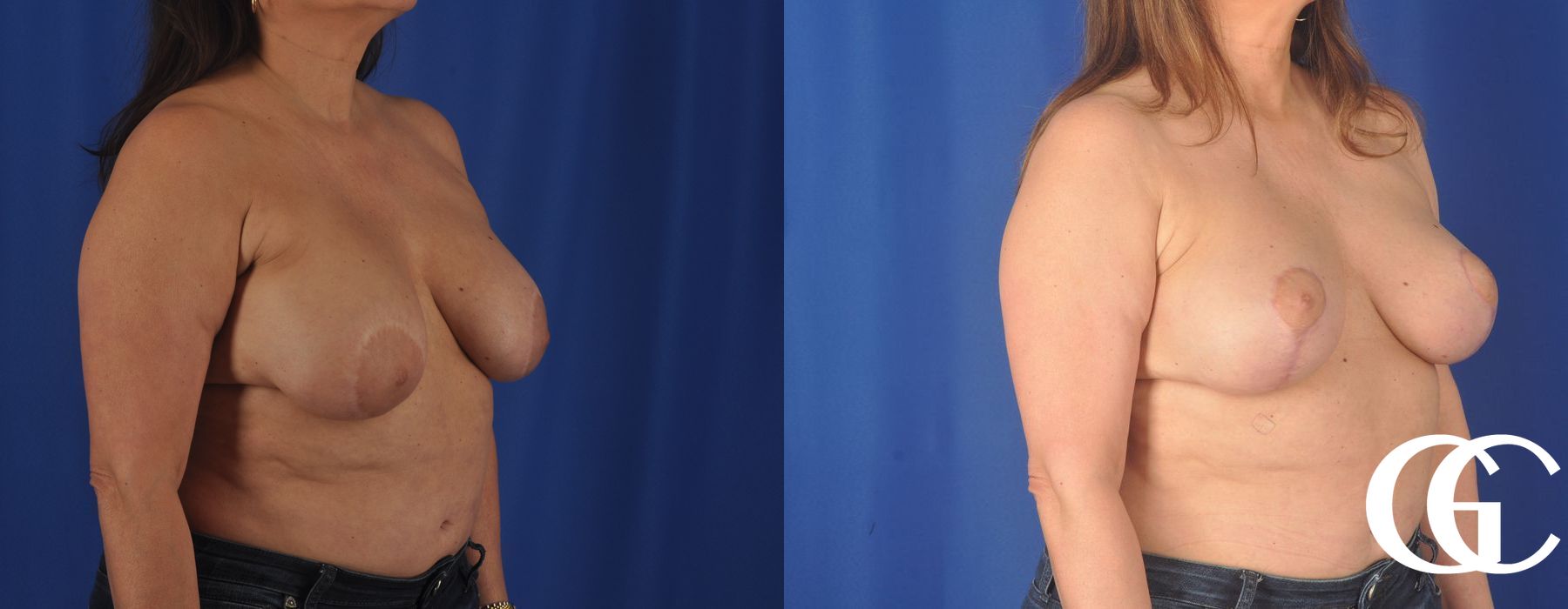 Liposuction - Thumbnail 2