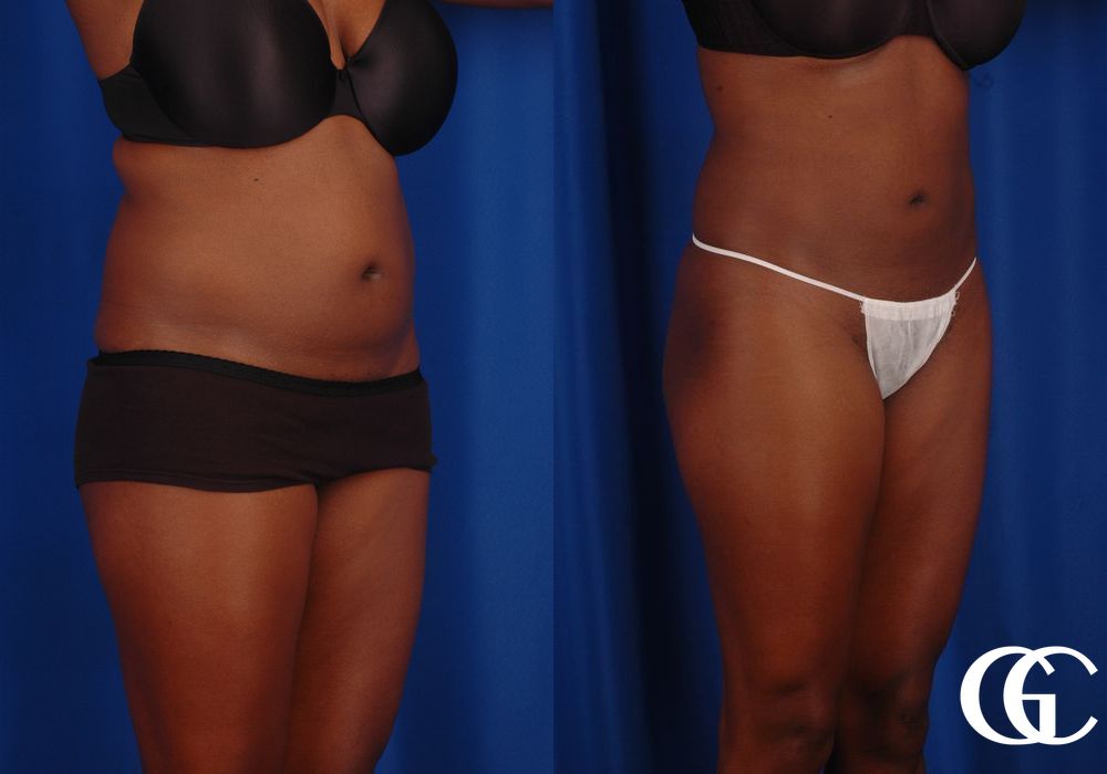 Liposuction - Thumbnail 3