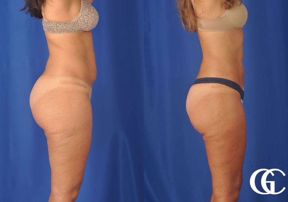 Liposuction - Thumbnail 4