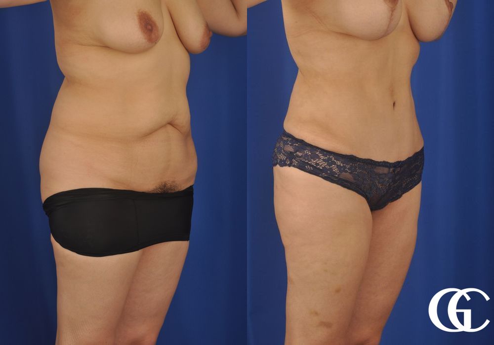 Liposuction - Thumbnail 4