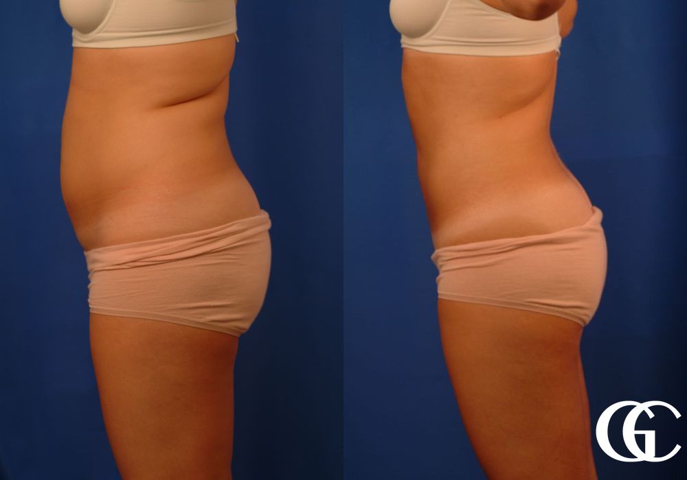 Liposuction - Thumbnail 4