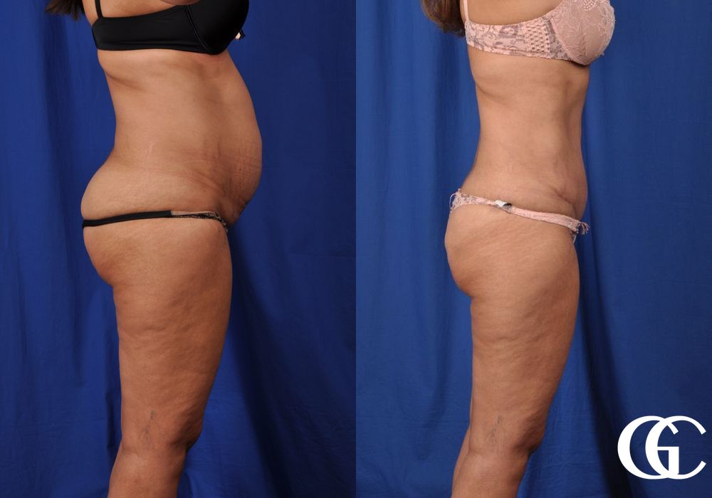 Liposuction - Thumbnail 3