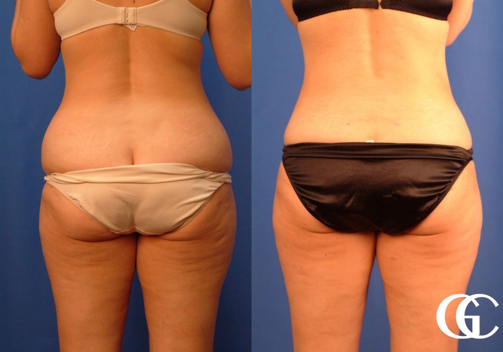 Liposuction - Thumbnail 4