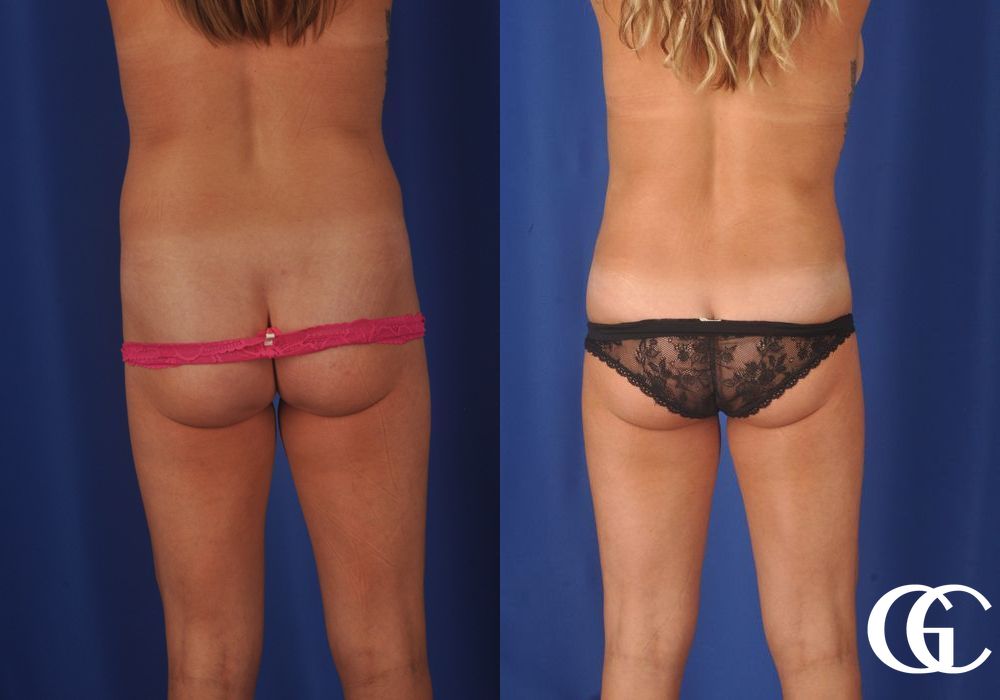 Liposuction - Thumbnail 4