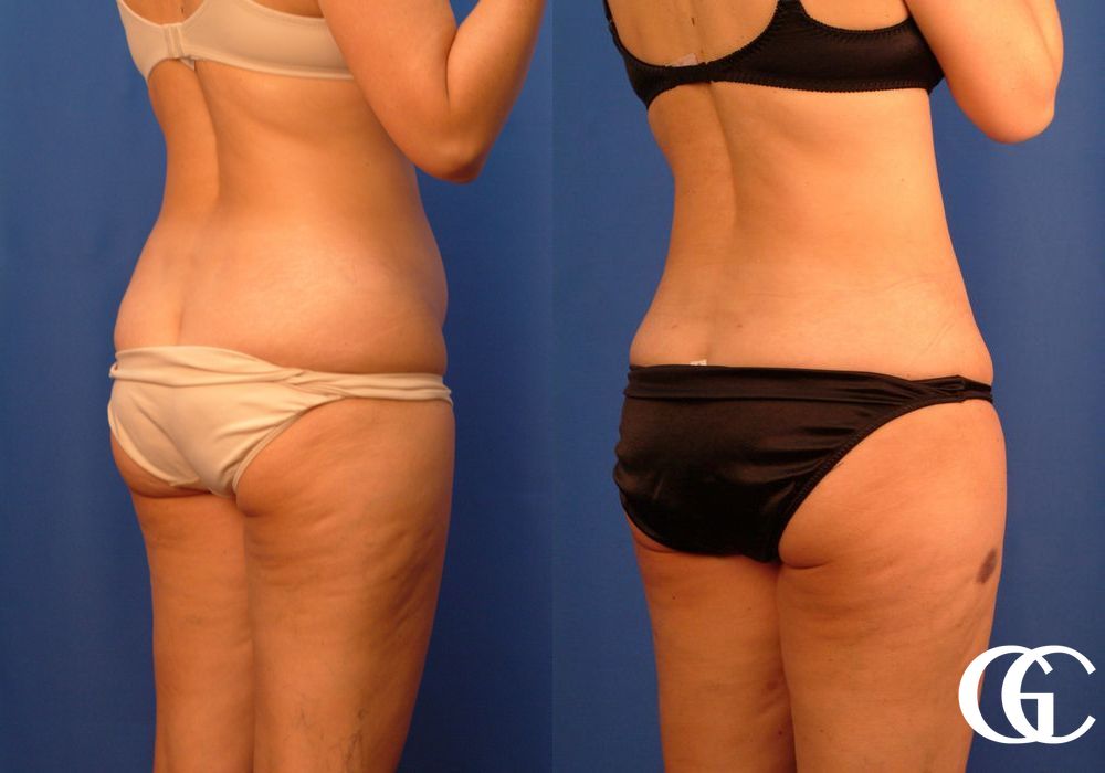 Liposuction - Thumbnail 3