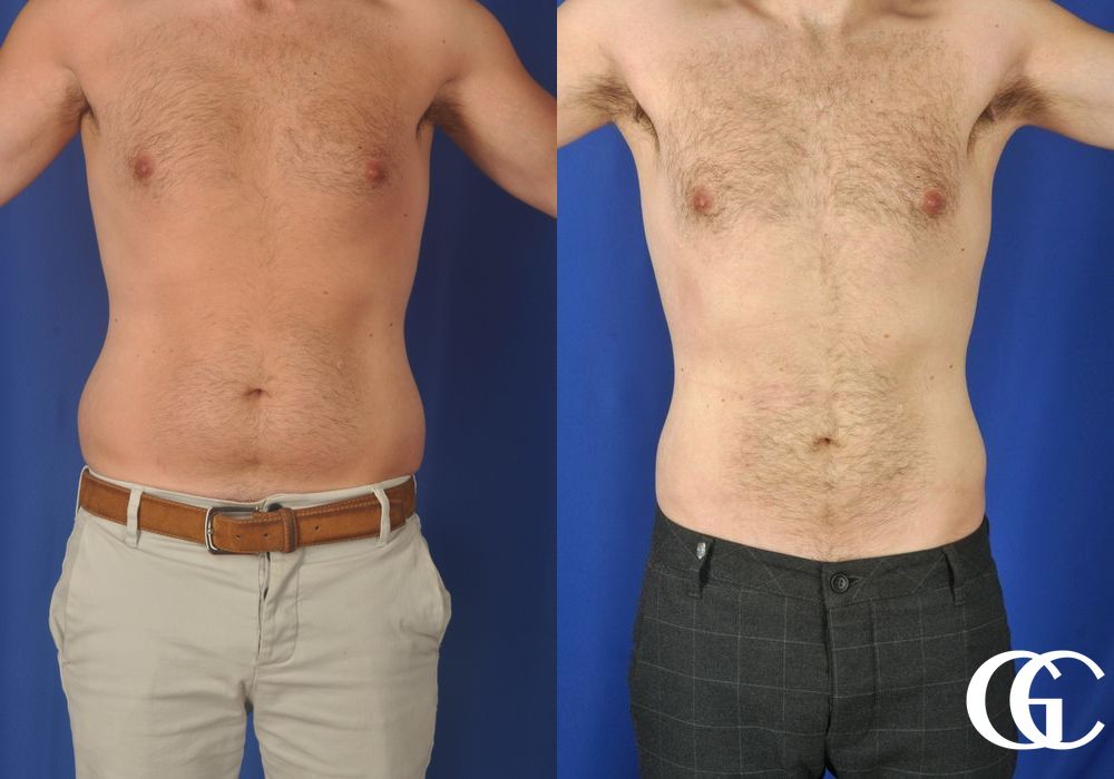 Liposuction - Case 6942