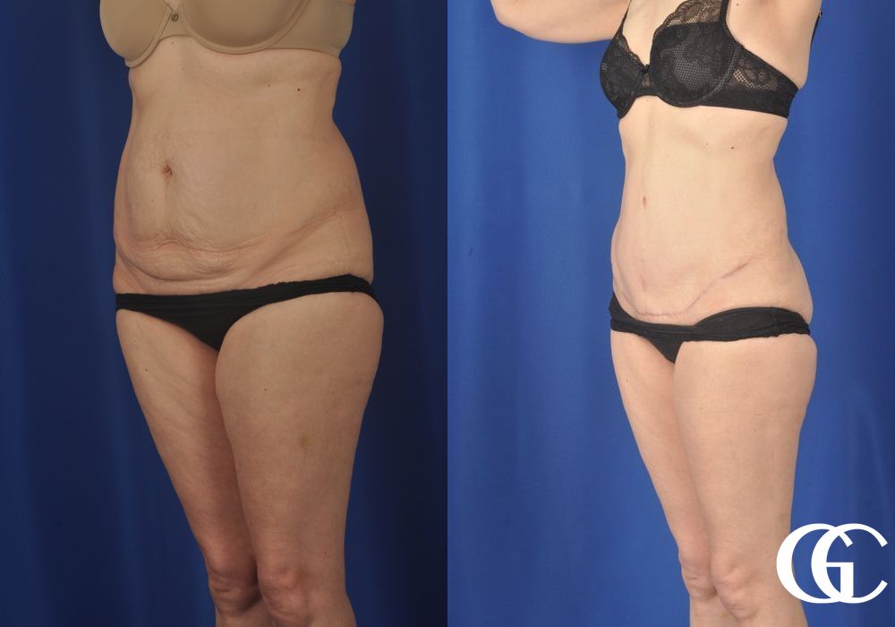 Liposuction - Thumbnail 4