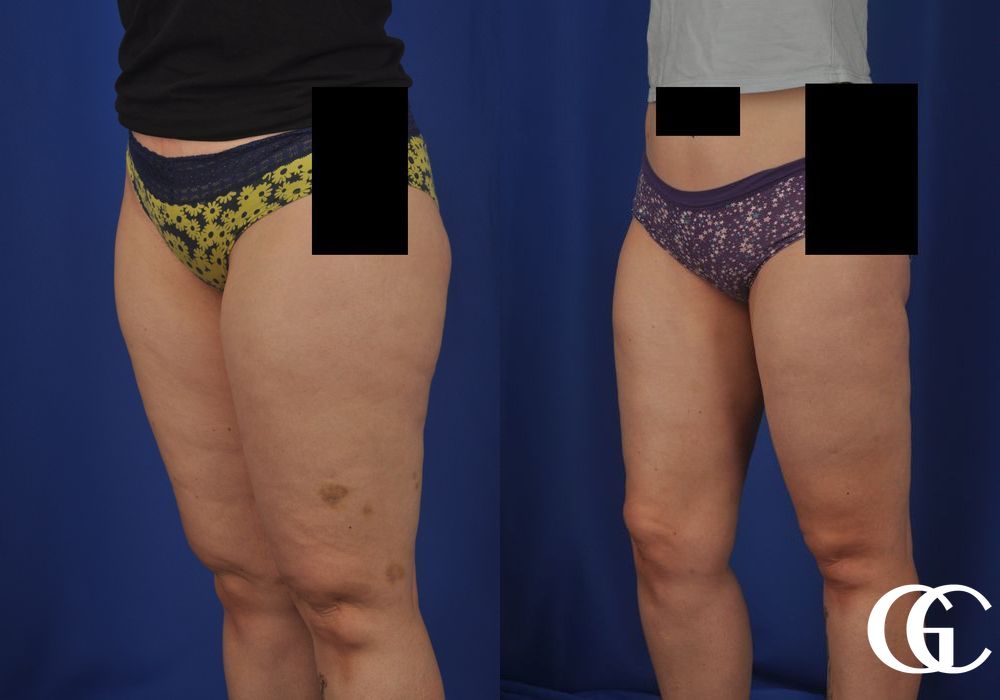 Liposuction - Thumbnail 3