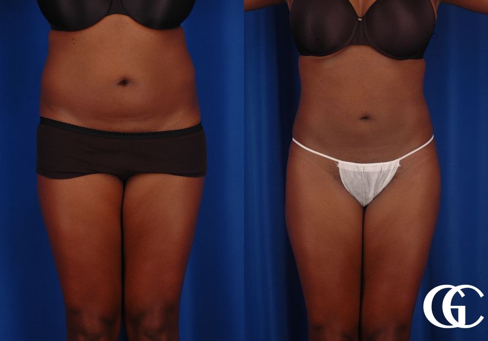 Liposuction - Thumbnail 2