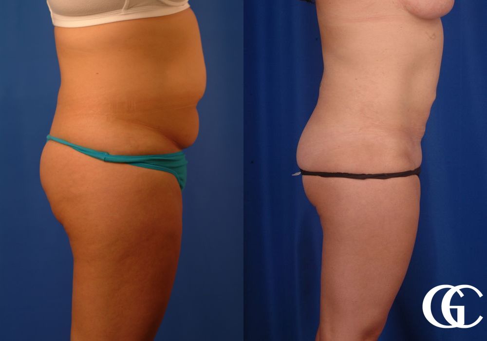 Liposuction - Thumbnail 2