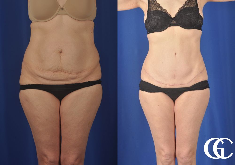 Liposuction - Case 6954