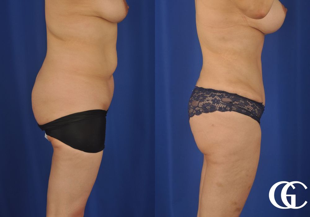 Liposuction - Thumbnail 5