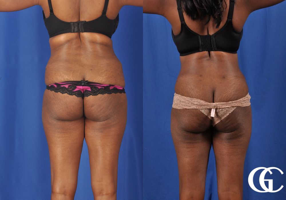 Liposuction - Thumbnail 4