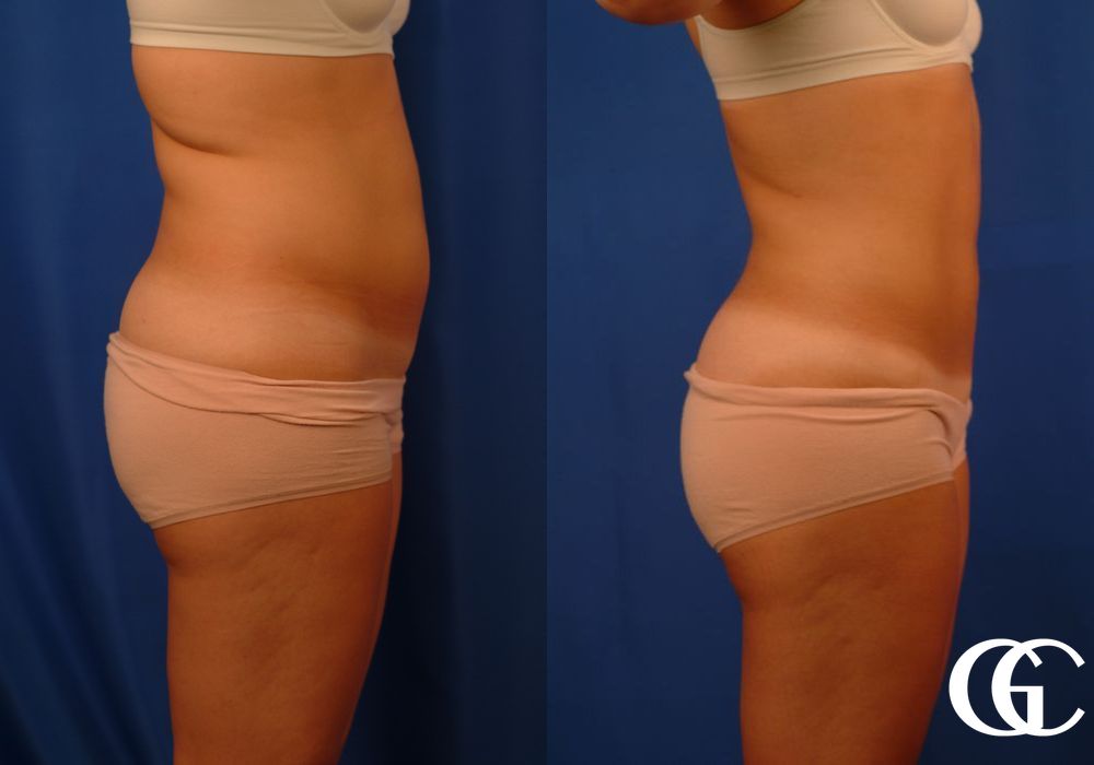 Liposuction - Thumbnail 3