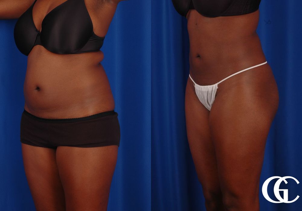 Liposuction - Thumbnail 5