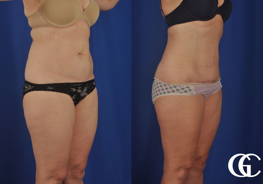 Liposuction - Thumbnail 2