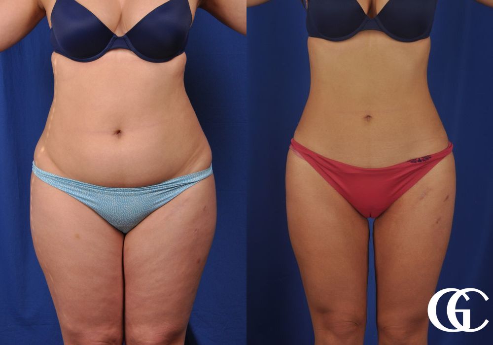 Liposuction - Case 6943