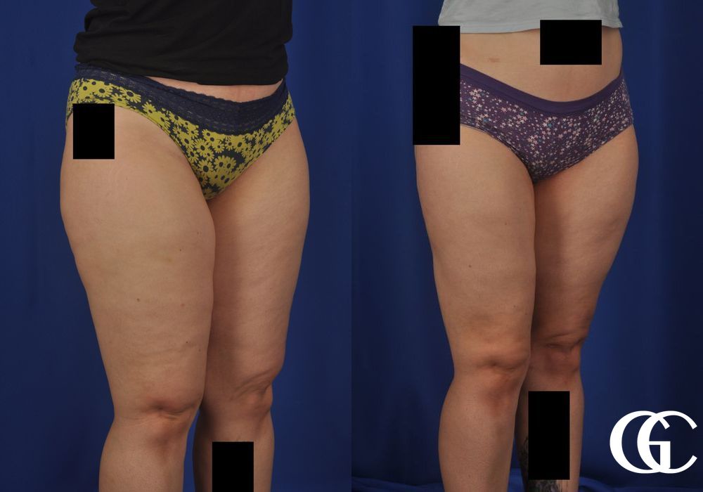 Liposuction - Case 6973