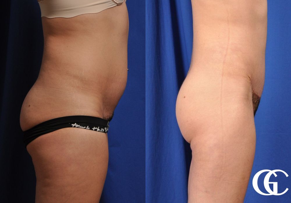 Tummy Tuck - Case 6986