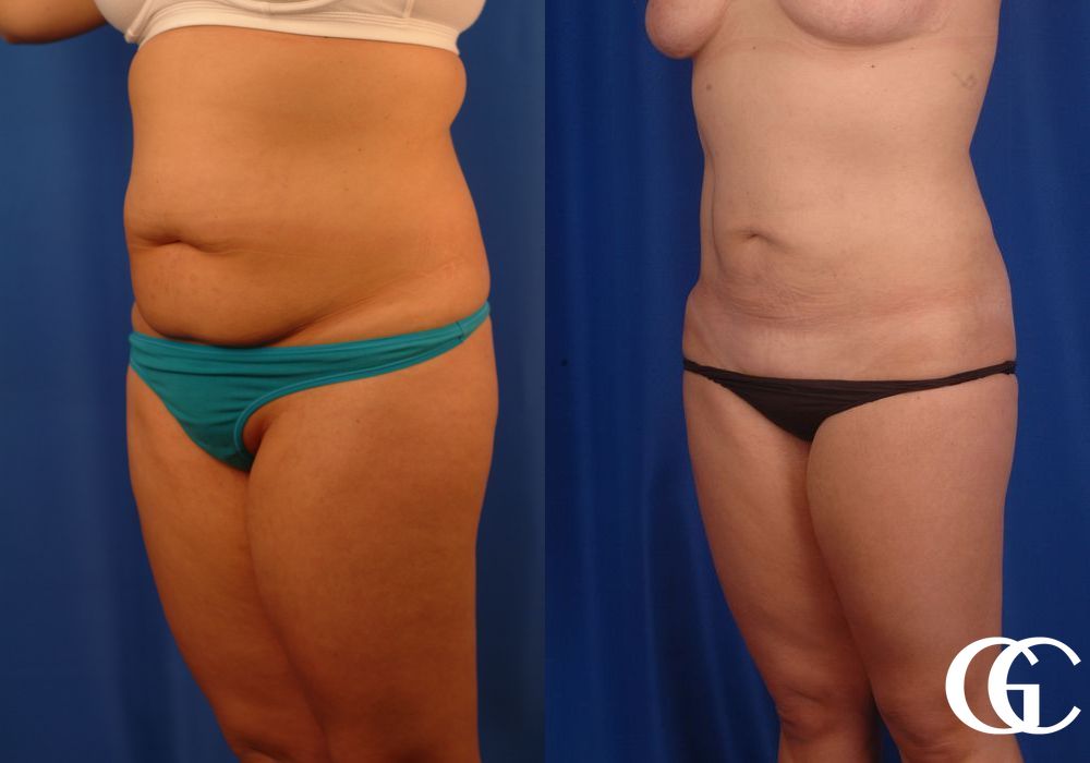 Liposuction - Thumbnail 3