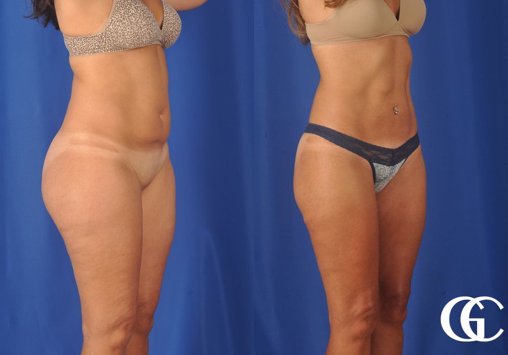 Liposuction - Thumbnail 3