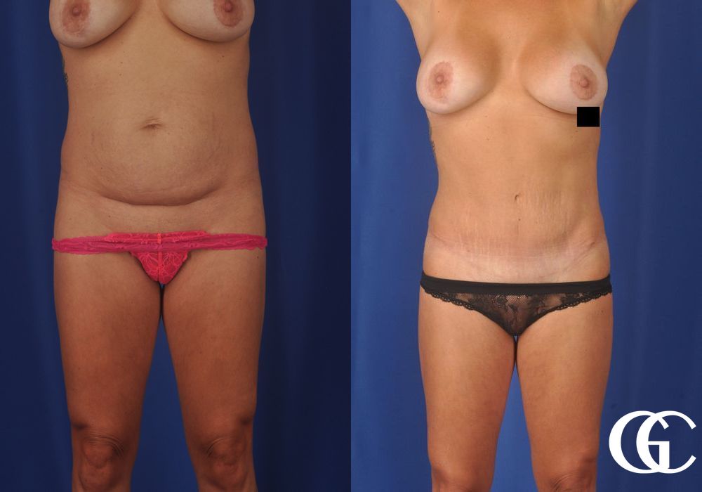Liposuction - Case 6964